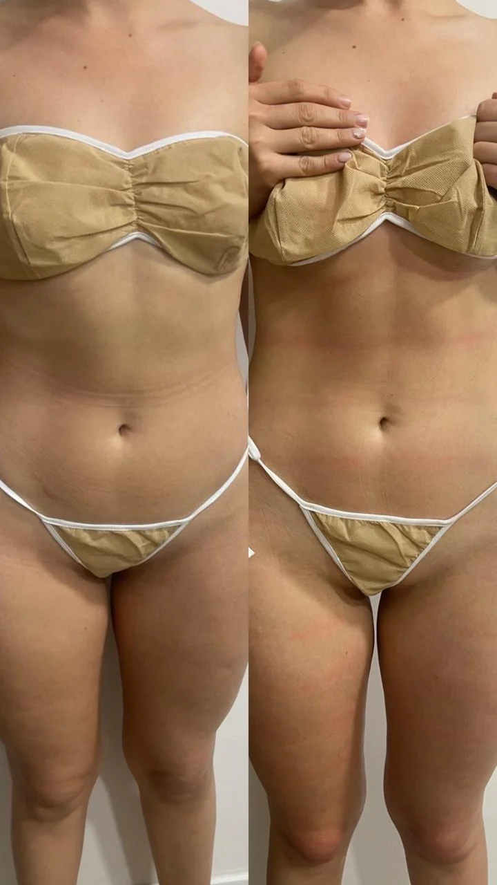 Antes y después de tratamiento de moldeamiento corporal en Chía